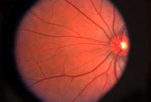 Macular Degeneration